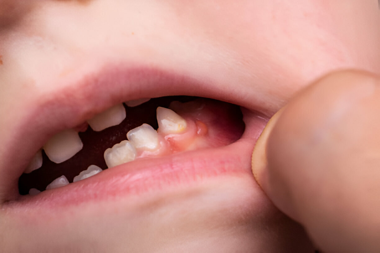 Gum Infection vs. Gum Disease: What's the Difference?_1