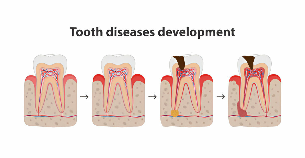 Gum Infection vs. Gum Disease: What's the Difference?_2