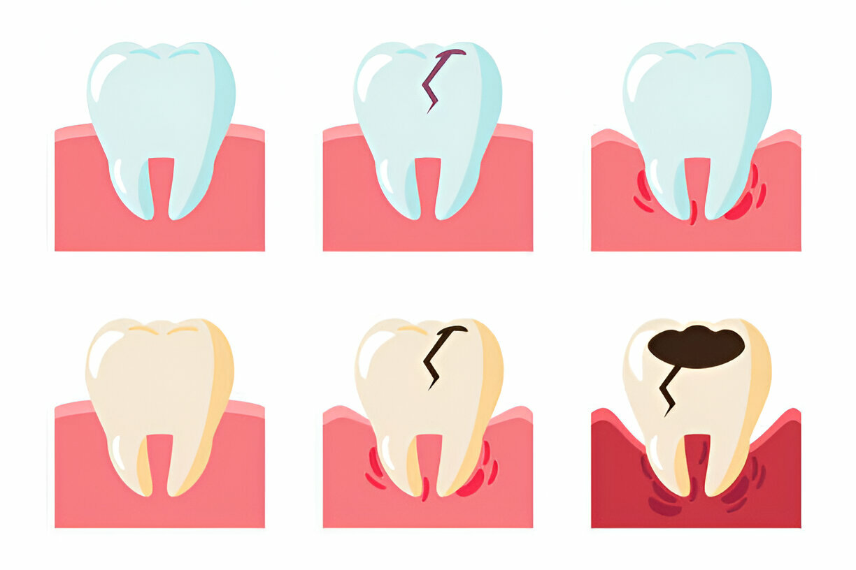 Gum Infection vs. Gum Disease: What's the Difference?_3