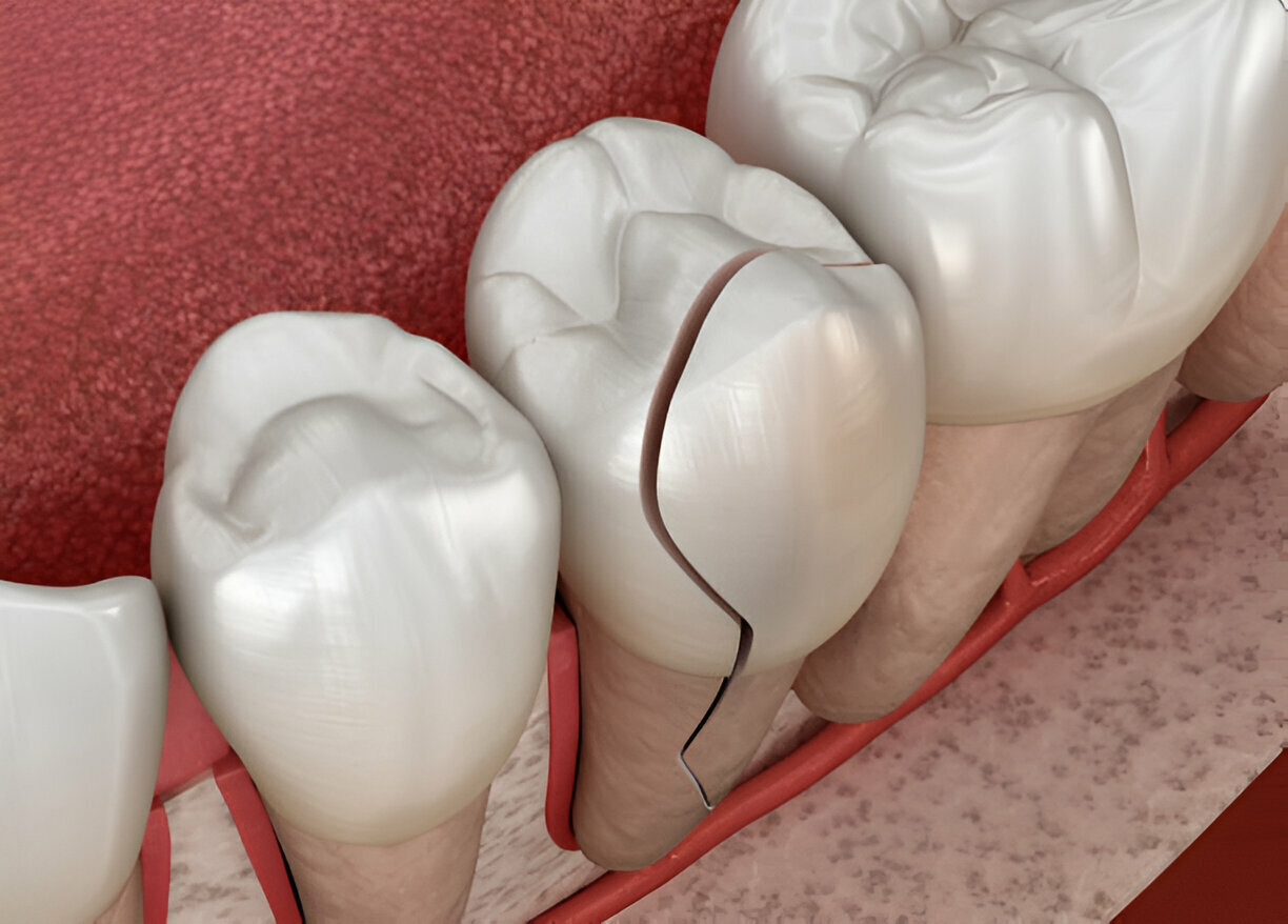 Handling Dental Emergencies: Expert Tips and Immediate Actions_2