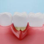 Navigating Gum Disease Treatments in Texas: Your Lubbock Dental Care Guide_FI