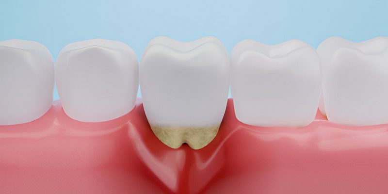 Navigating Gum Disease Treatments in Texas: Your Lubbock Dental Care Guide_FI