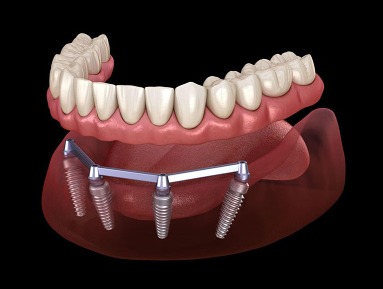 The All-On-4® Technique