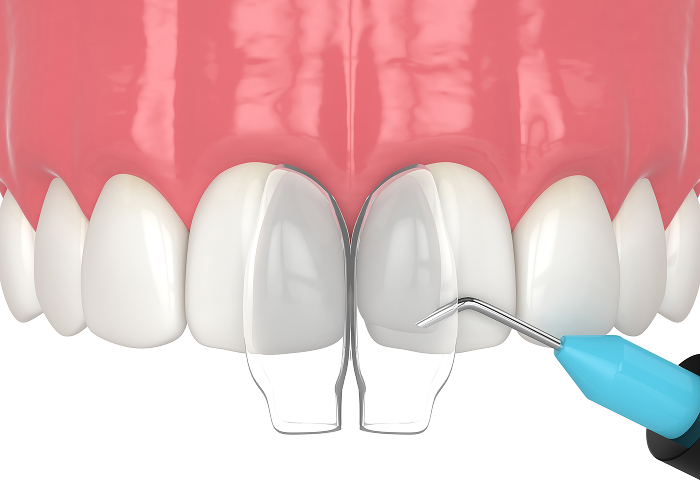 Dental Bonding