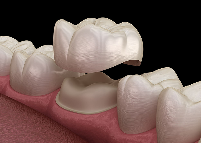 Dental Crowns
