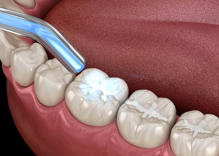 Dental Sealants