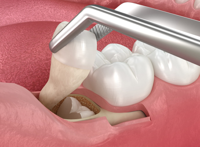 Tooth Extractions