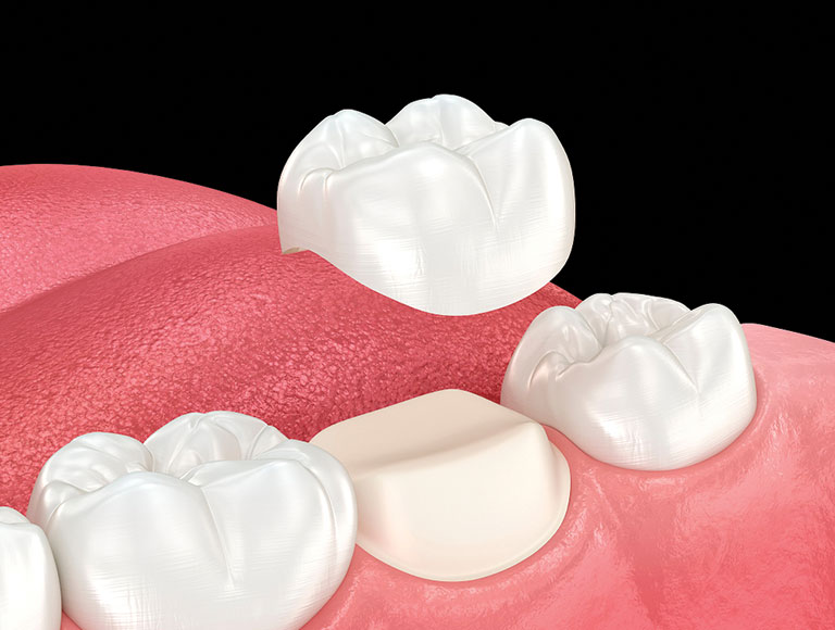 Dental Crown