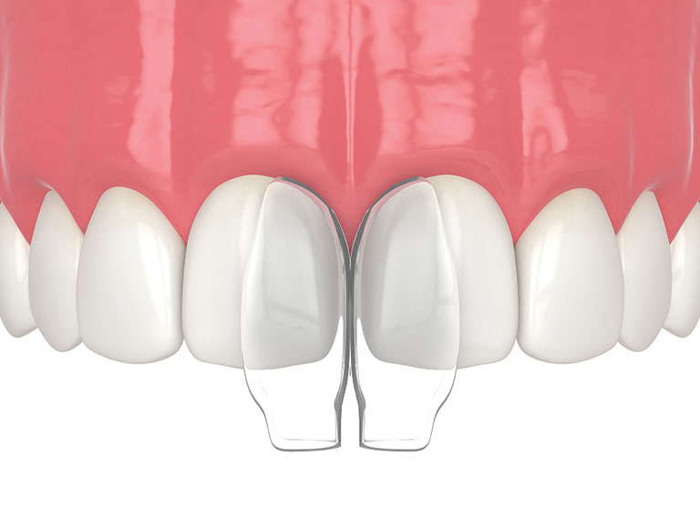Dental Bonding