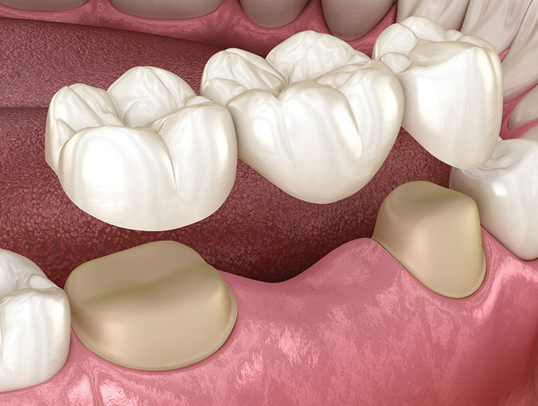Dental Bridge