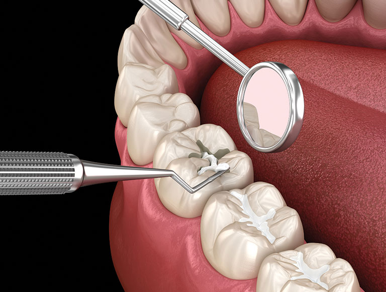 Dental Sealants