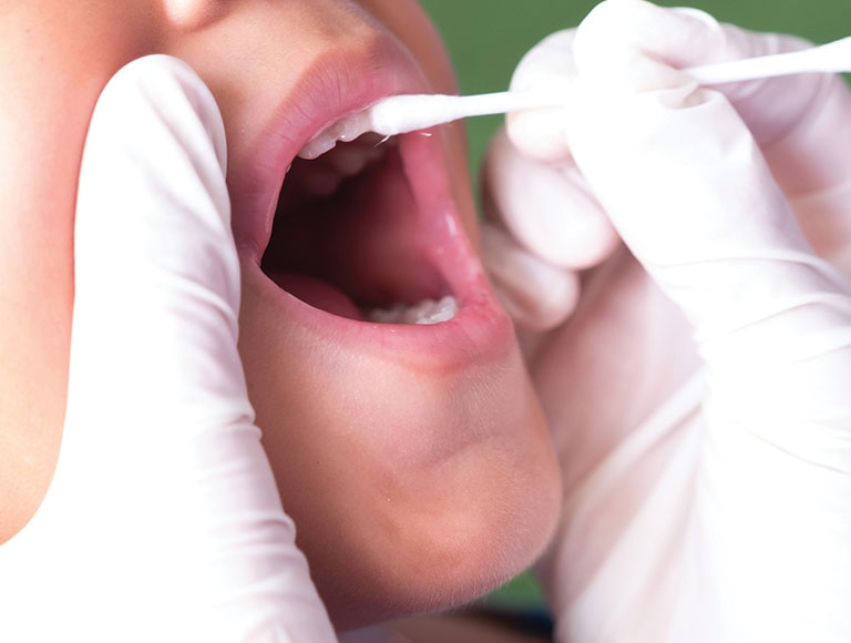 Fluoride Treatments
