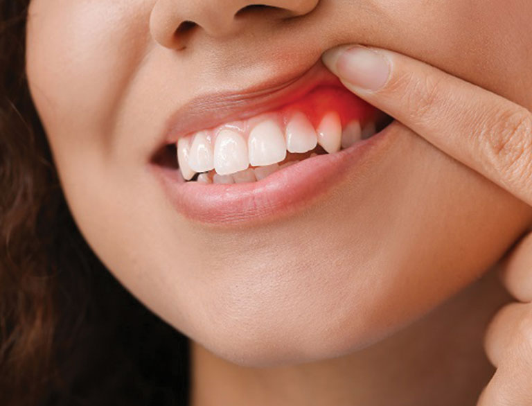 Gum Disease Treatment