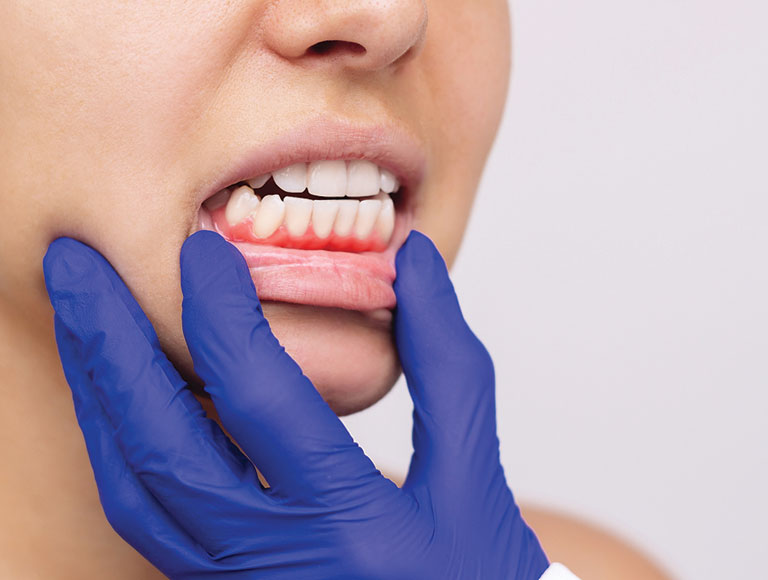 Gum Disease Treatment