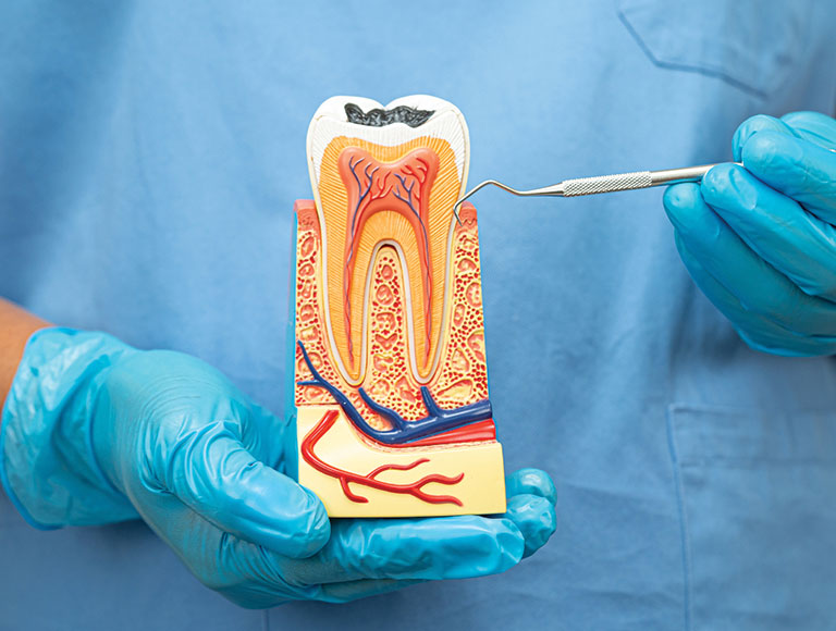 Root Canal Treatment