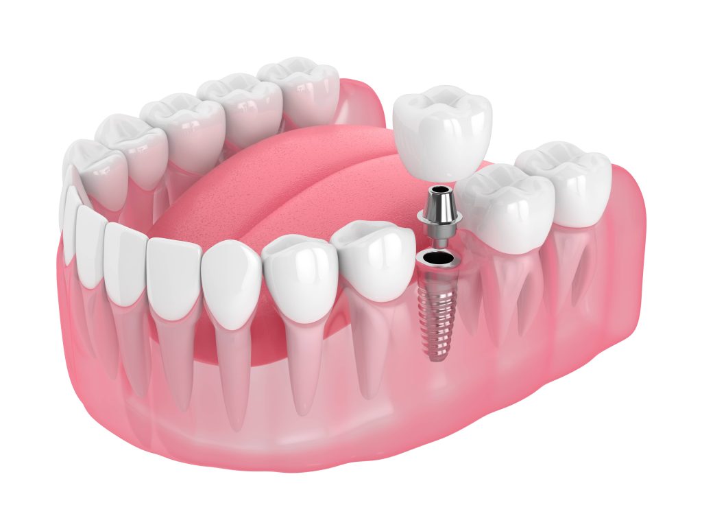Single Tooth Replacement
