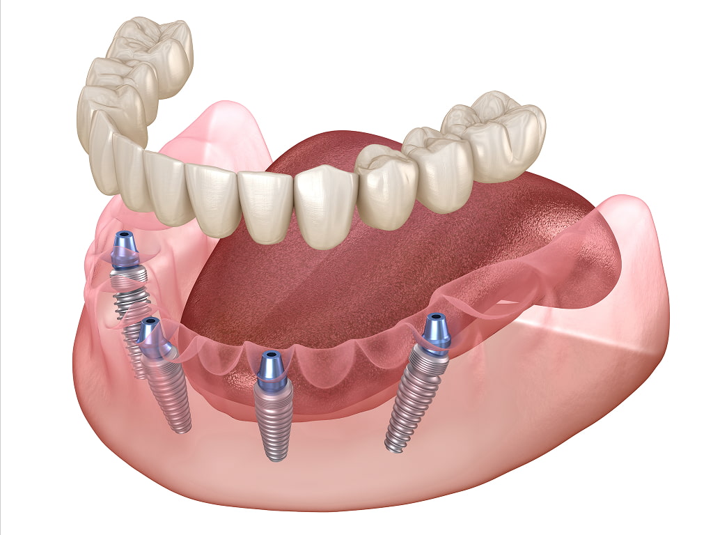 Full-Arch Replacement