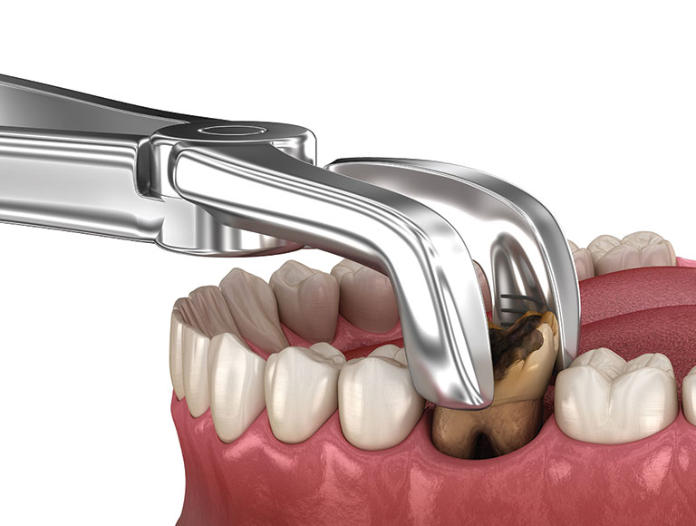 Tooth Extractions