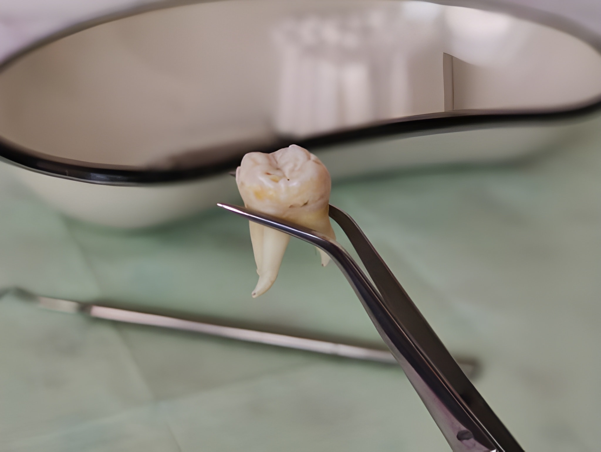 From Toothache to Relief: Tooth Extractions Made Simple at Lubbock Dental Care_FI